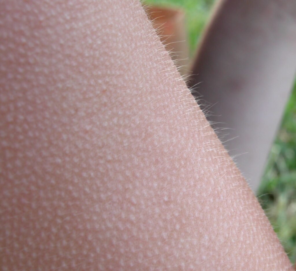 Close-up of goosebumps on a person's arm